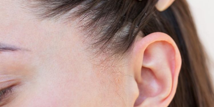 Jak dobrać odpowiedni szampon przeciwłupieżowy - przyczyny łupieżu